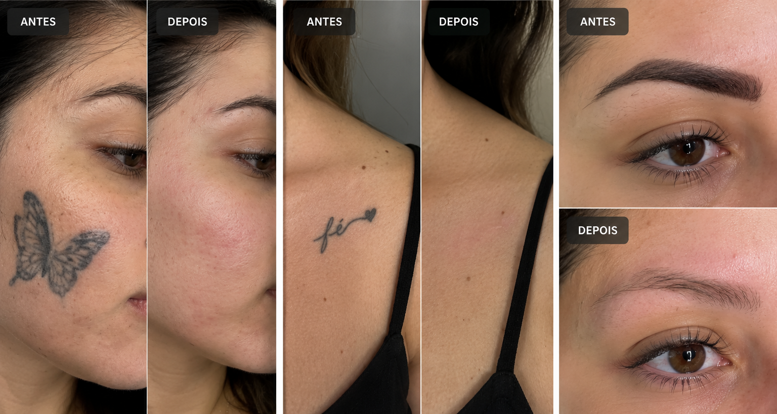 Antes e Depois Remoção a Laser